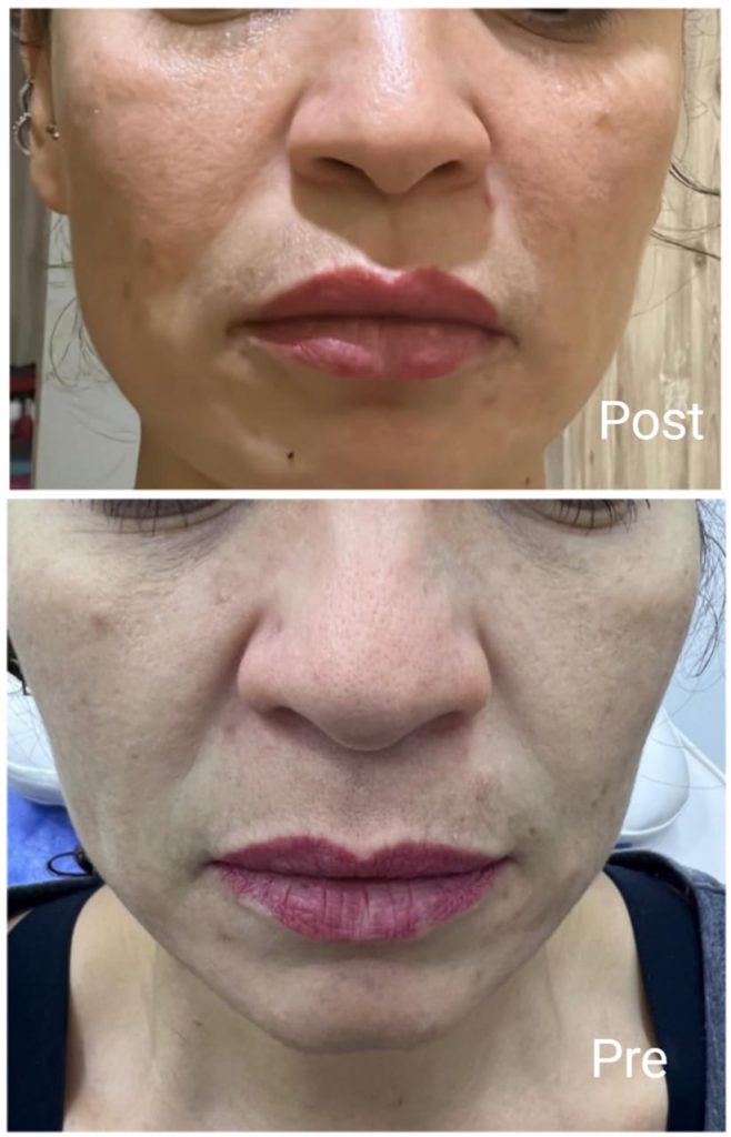 نفخ الخدود في الغردقة